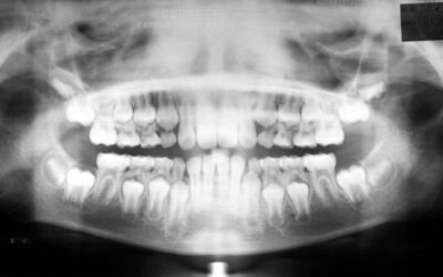 智齒的發育 wisdom teeth growth