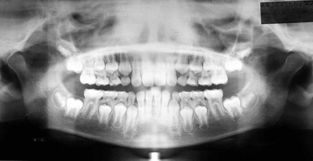 智齒的發育 wisdom teeth growth