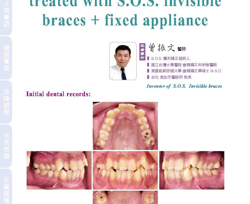 A 4 bicuspids extraction case treated with S.O.S. invisible braces + fixed appliance｜曾醫師學術專欄｜天母美加牙醫診所