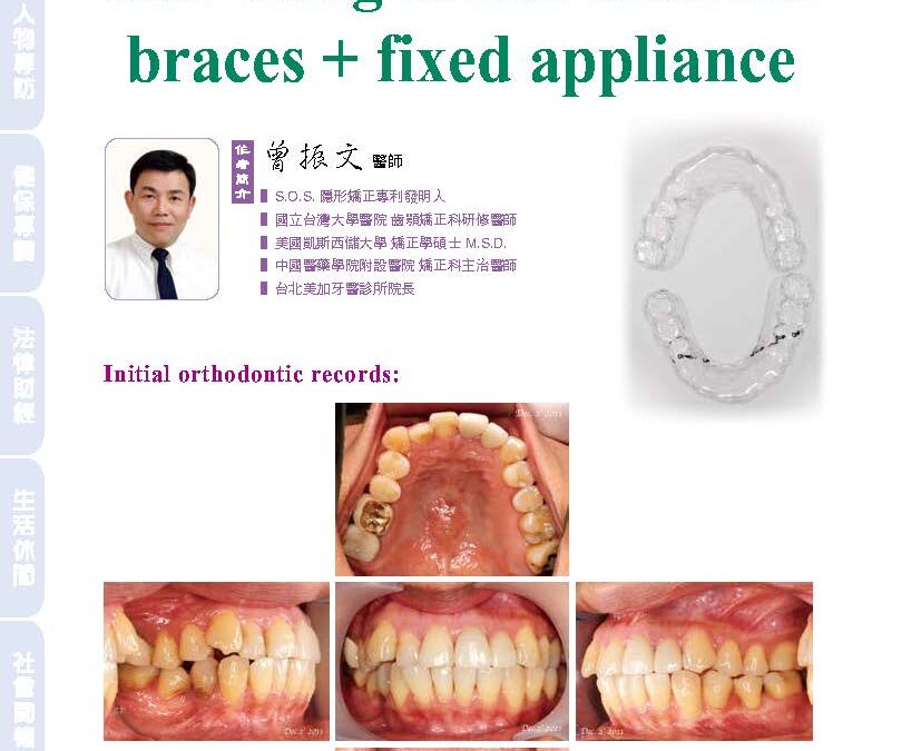 An orthodontic extraction case using S.O.S. invisible braces + fixed appliance｜曾醫師學術專欄｜天母美加牙醫診所
