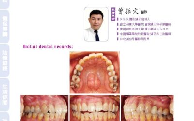 An orthodontic crowding case treating with S.O.S. invisible braces｜曾醫師學術專欄｜天母美加牙醫診所