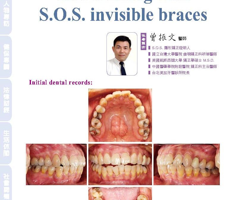 An orthodontic crowding case treating with S.O.S. invisible braces｜曾醫師學術專欄｜天母美加牙醫診所