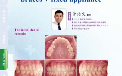 An orthodontic relapse case treated with S.O.S. invisible braces + fixed appliance｜曾醫師學術專欄｜天母美加牙醫診所