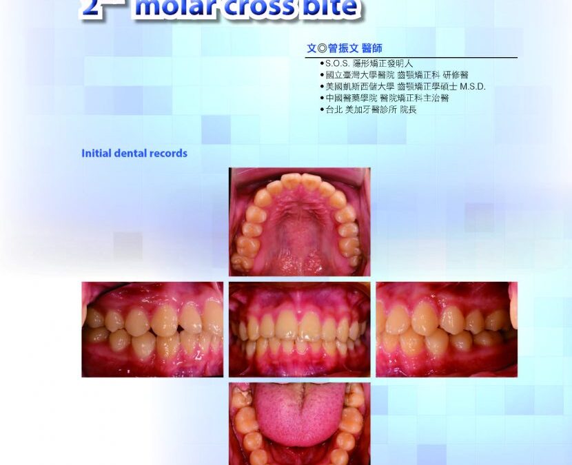 An early Tx. case using S.O.S invisible braces for 2 molar cross bite｜曾醫師學術專欄｜天母美加牙醫診所